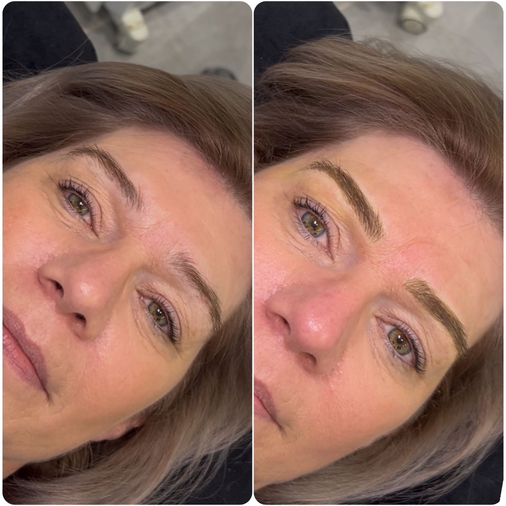 Brow treatment result