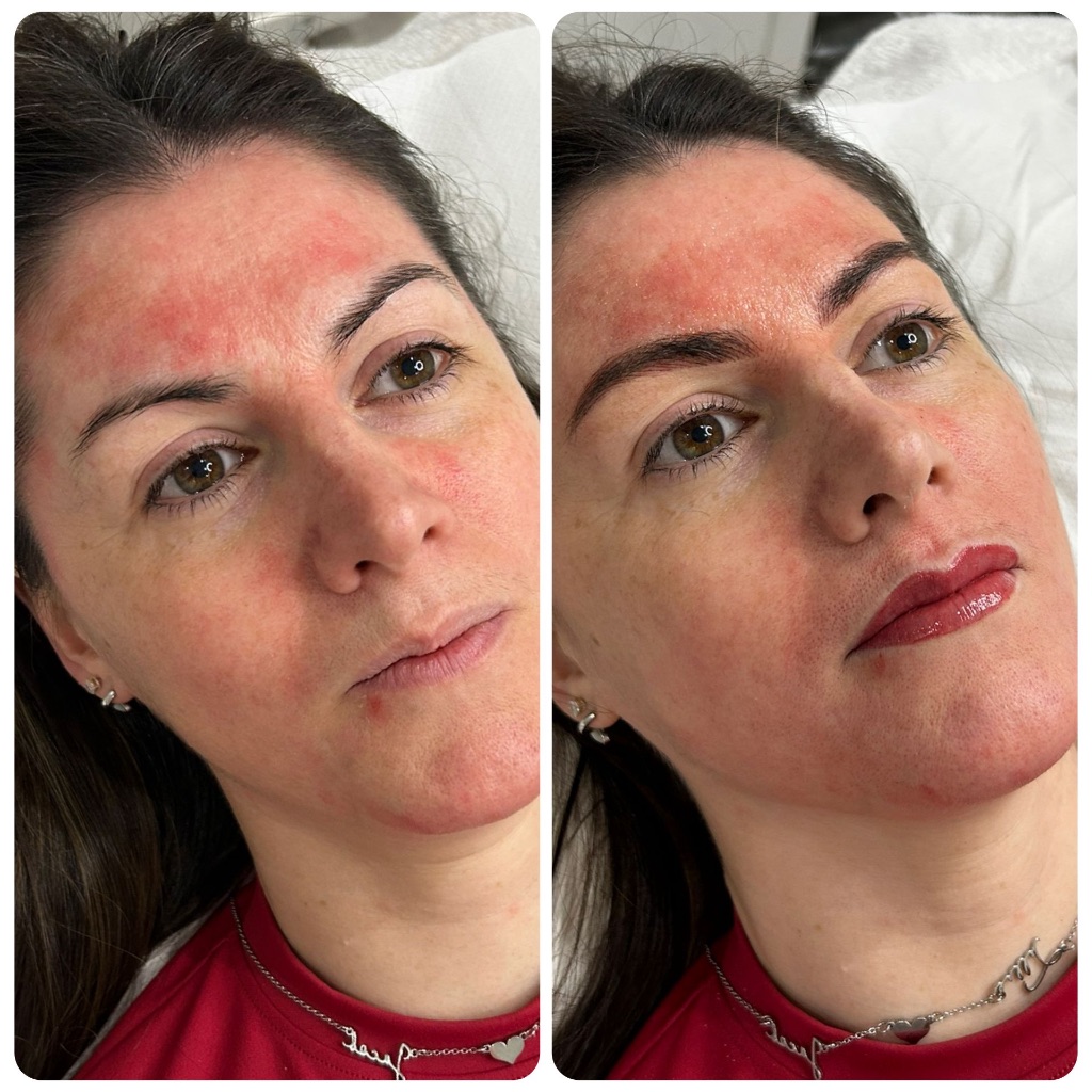 Lip blush after result